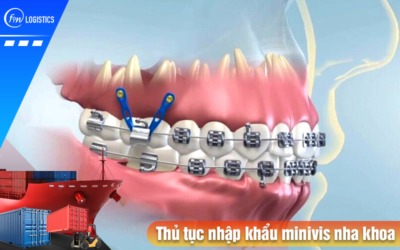 Thủ tục nhập khẩu minivis nha khoa cần phải lưu ý những quy định pháp luật nào? 6 Thu-tuc-nhap-khau-minivis-nha-khoa